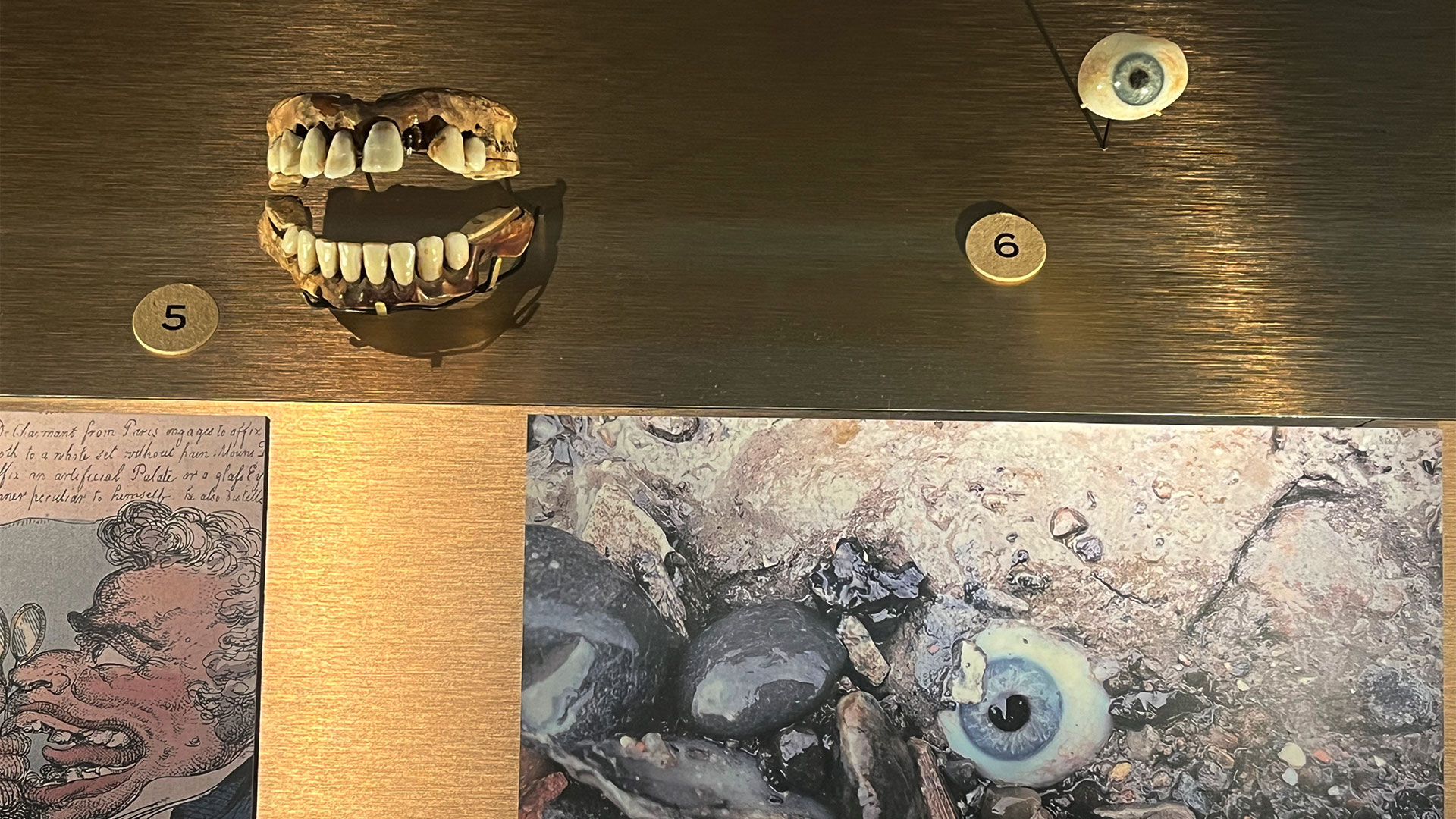 A prosthetic eye and a set of dentures are on display at London Museum Docklands.